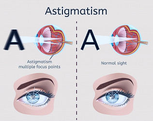 Lasik Eye Surgery Cost for Astigmatism | Excel Eye